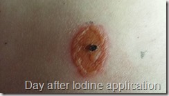 Day after Iodine attempt. 