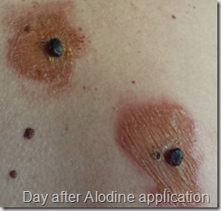 Day after Iodine application.